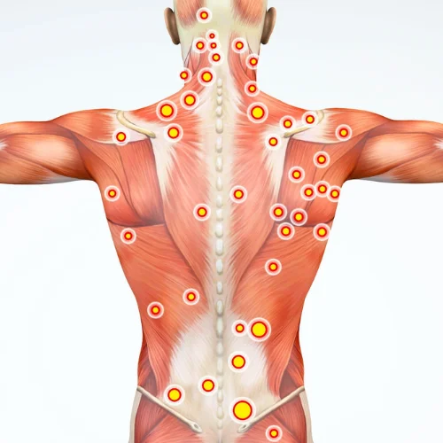 Myofascial Pain Syndrome / Trigger Points